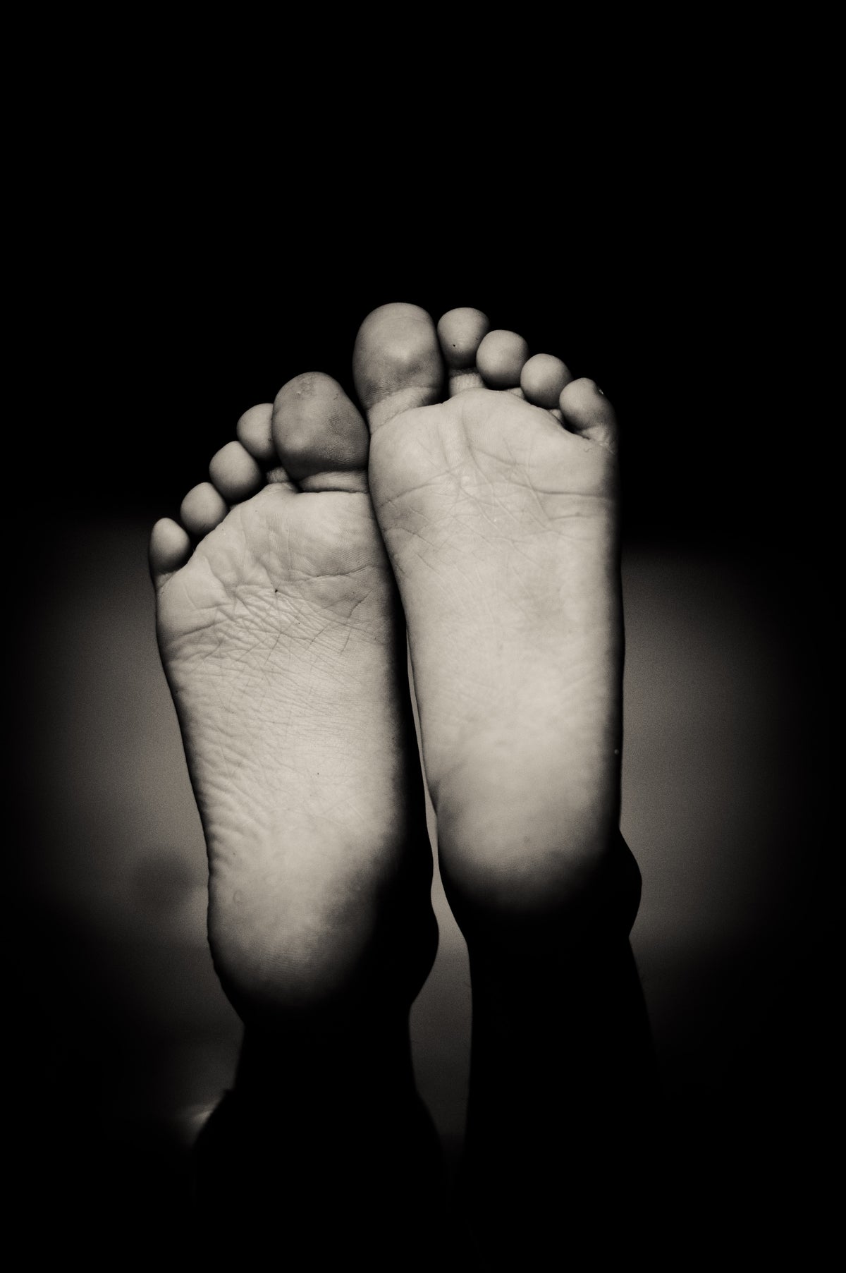 Grierson-Gopalan Syndrome (Burning Feet): Causes, Treatment & Home Remedies